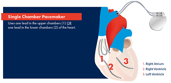 Types of Chamber Pacemakers